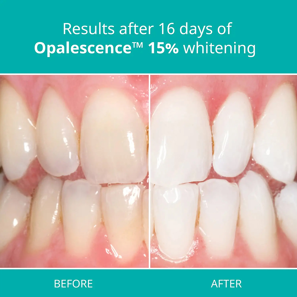 Opalescence Professional White - Teeth Whitening Gel Opalescence ulasan dan harga