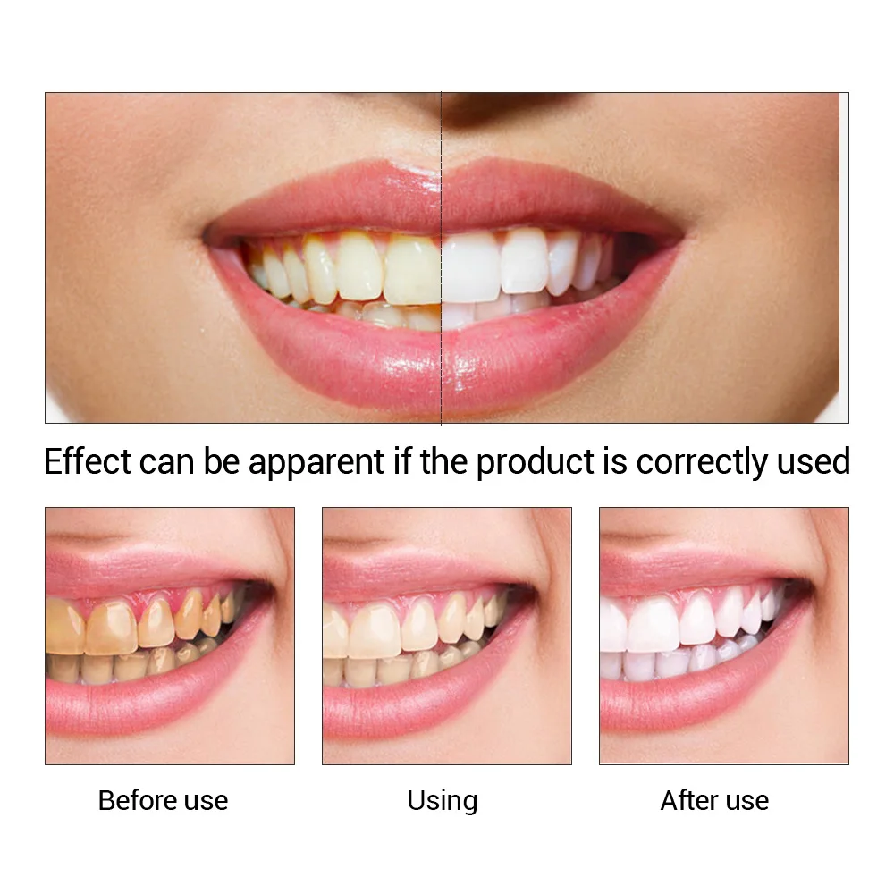 FTEENPLY Teeth Whitening Essen - Teeth Whitening At Home ulasan dan harga