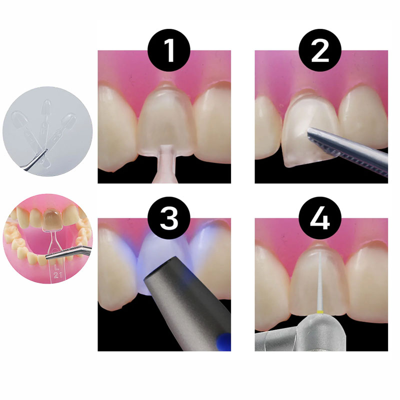 32pcs/Set Composite Resin Mold - Teeth Whitening Moulds ulasan dan harga