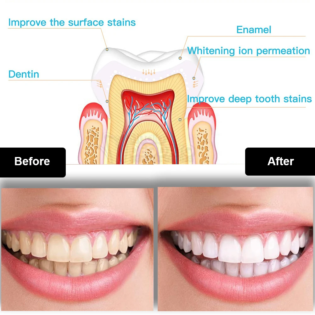 Dental Teeth Whitening Kit Min - Teeth Whitening Pen ulasan dan harga