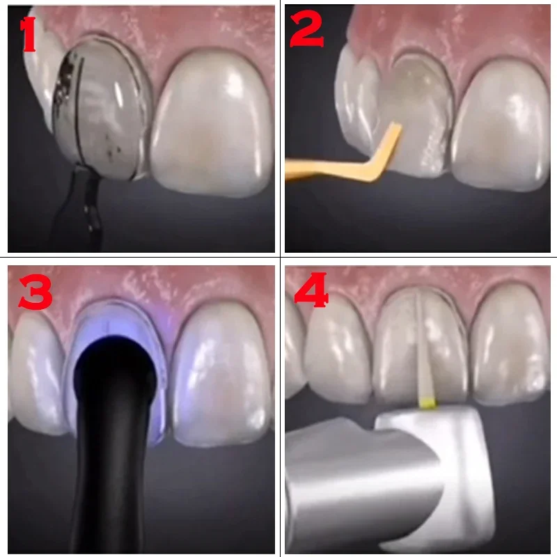 Dentals Mould For Composite Re - Teeth Whitening Moulds ulasan dan harga