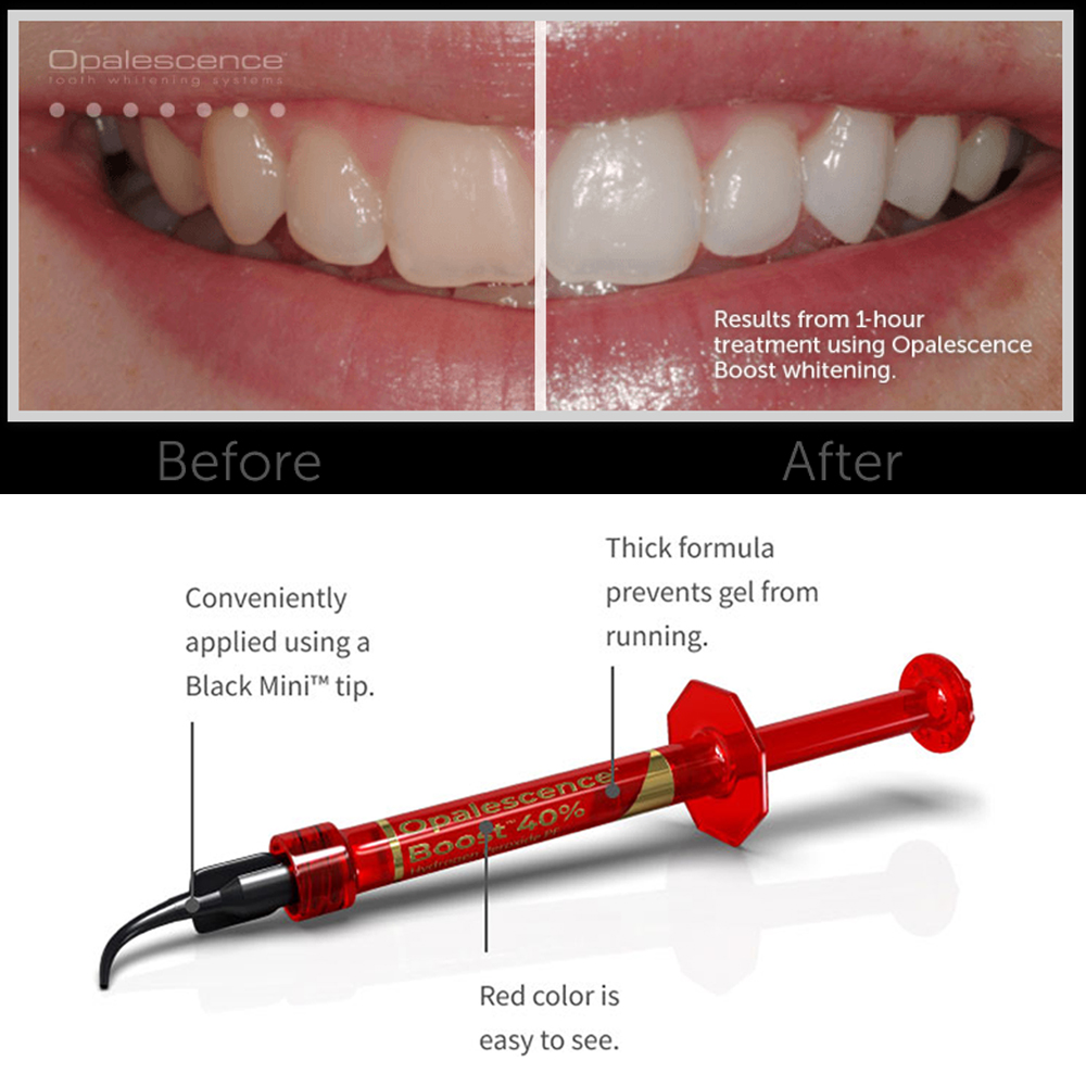 Ultradent Opalescence Boost PF - Teeth Whitening Gel Opalescence ulasan dan harga