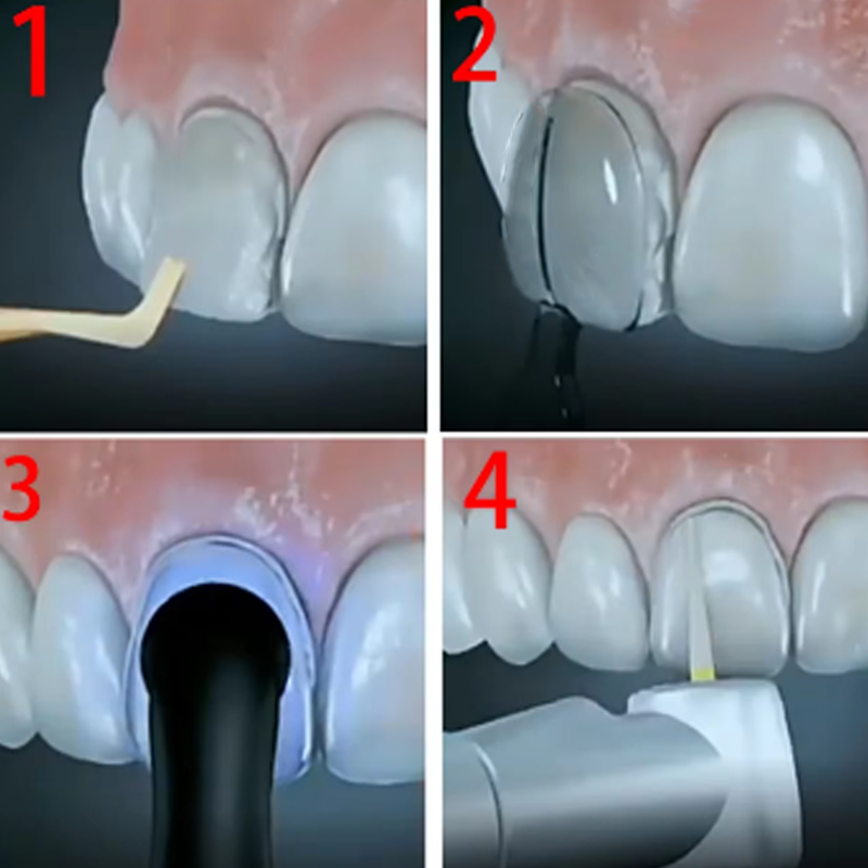32Pcs/Box Dental Veneer Mould  - Teeth Whitening Moulds ulasan dan harga